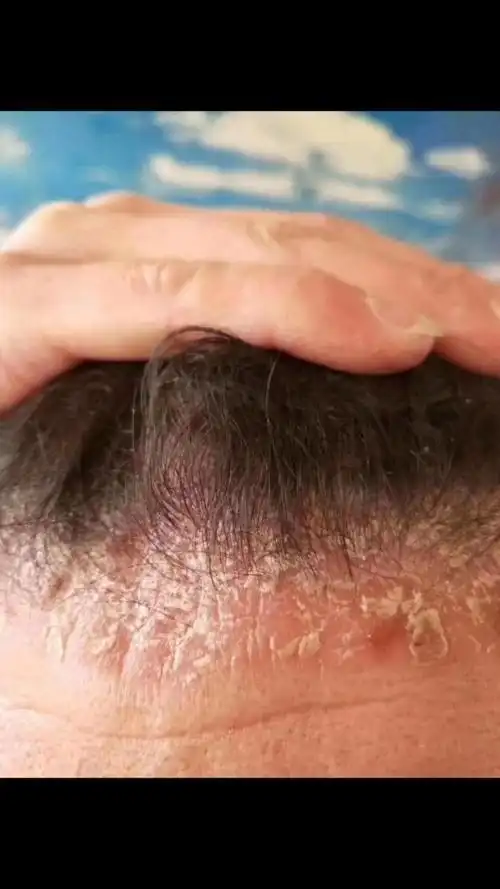 头癣一般是由真菌感染的,具有传染性,越早治疗越好