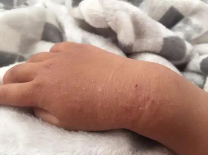 2岁宝宝手上突然长这种疙瘩是怎么回事?