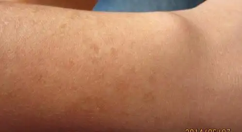 如图 皮肤上的斑点是怎么回事?