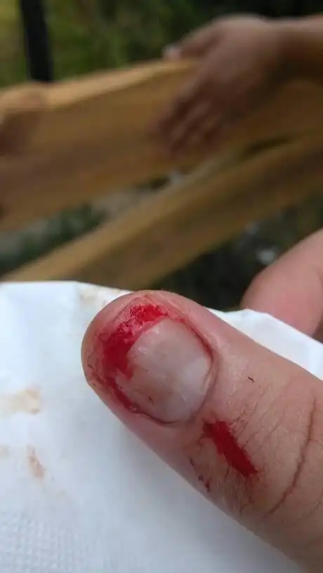 指甲摔断了 怎么办 医生