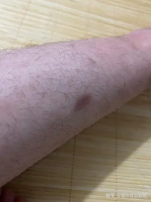 腿上有这种淤青是怎么回事啊