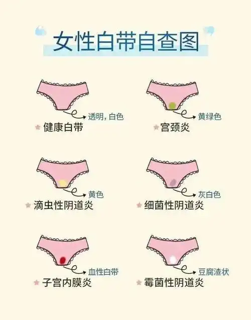 白带有4种情况,要警惕妇科疾病!华克维两性霉素b阴道泡腾片