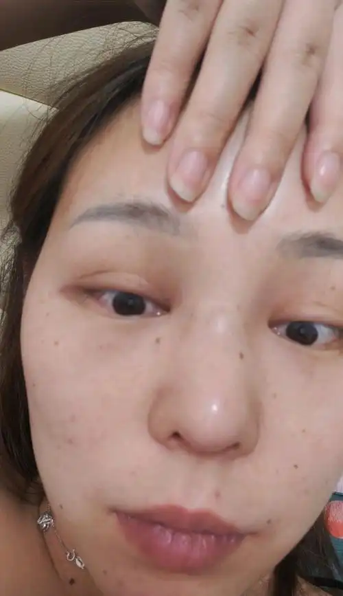 耳软骨隆鼻20多天,山根鼓了一个硬包,怎么回事?