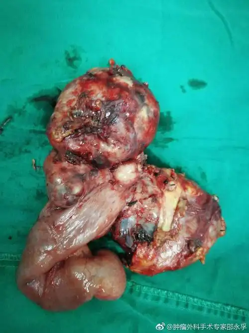 这是邵永孚去海南为病人切除的部份恶性肿瘤,如有不适望不要观看.