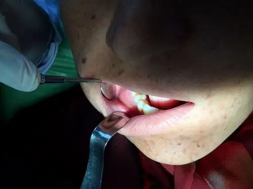 三院援疆医生王俊文开展伽师总场医院首例颌骨囊肿摘除术