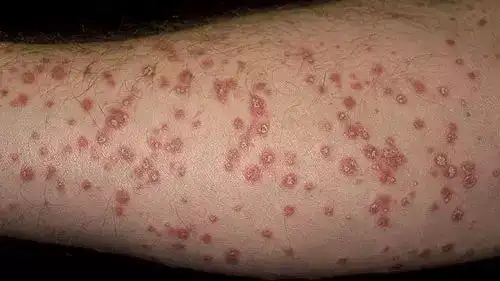 头部银屑病好转的迹象图片