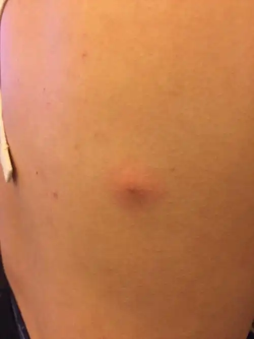 背部皮肤里长了一个硬块 有点痒 按了有点疼.没有其他反应.