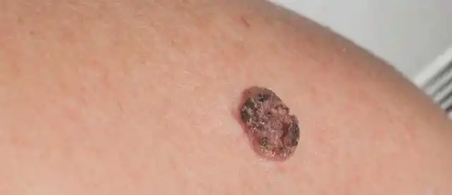 皮肤上凸起的小疙瘩是什么,别大意|血管瘤|肿瘤|增生|癌变|丘疹_网易