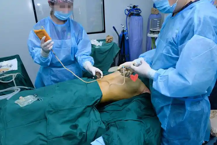 做了自体脂肪丰胸手术是怎样的体验