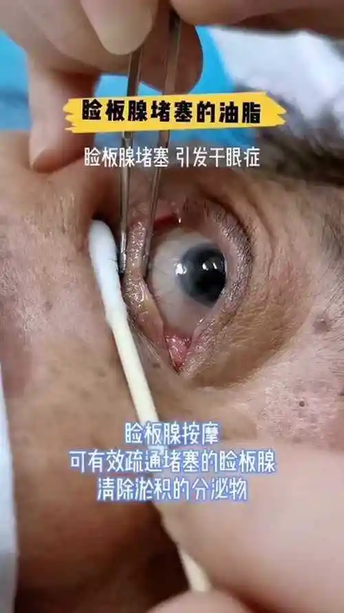 眼睛干涩不舒服,小心睑板腺堵塞引起干眼症!_腾讯视频
