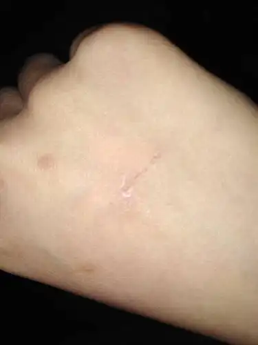 被猫抓伤需要打针吗