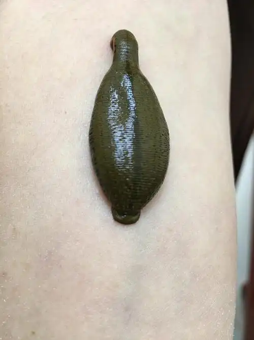 水蛭疗法(手机随拍)