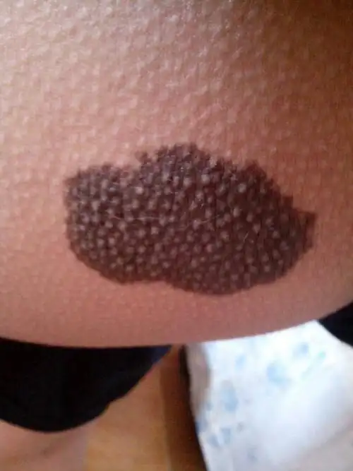 我屁股上长一个大黑痣,有二分之一食指长,三分之二食指宽!