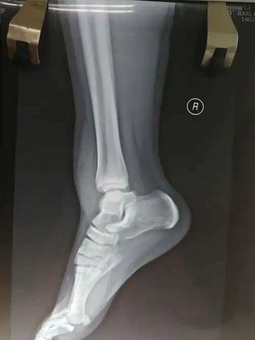 张豪,男,12岁,内外踝骨折