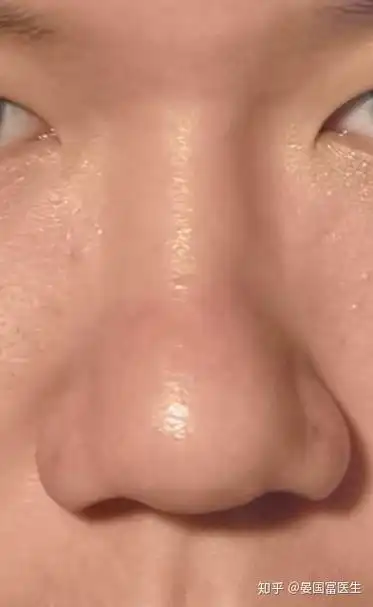 鼻头圆怎么缩小