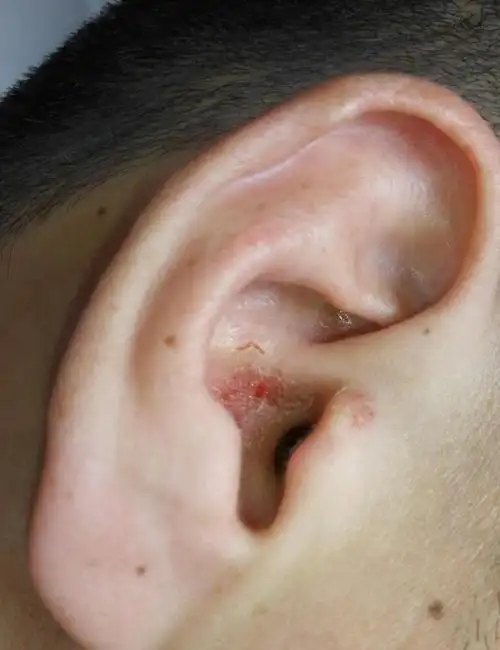 外耳道生疮,结痂,渗液 - 皮肤及性传播疾病讨论版 - 爱爱医医学论坛