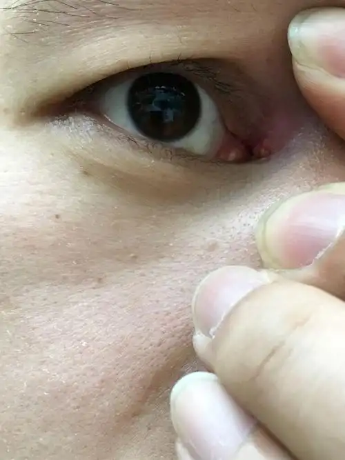 能看到脓头了,要怎么办?不管他还是去医院割了