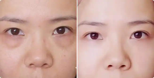 李世荣内切去眼袋怎么样内切去眼袋案例效果对比图重庆星荣整形外科