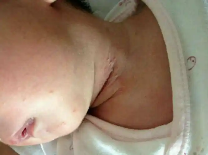 耳朵后边的皮脂腺囊肿图片