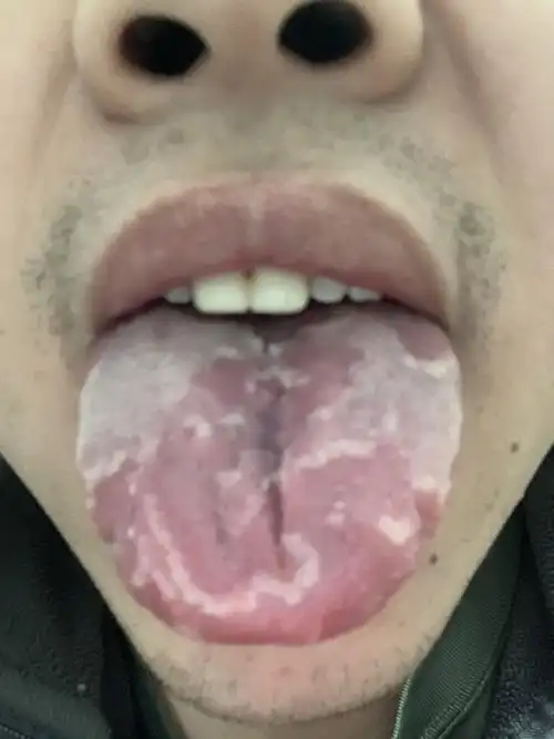 舌头开裂白斑疼痛.得了什么大病吗?