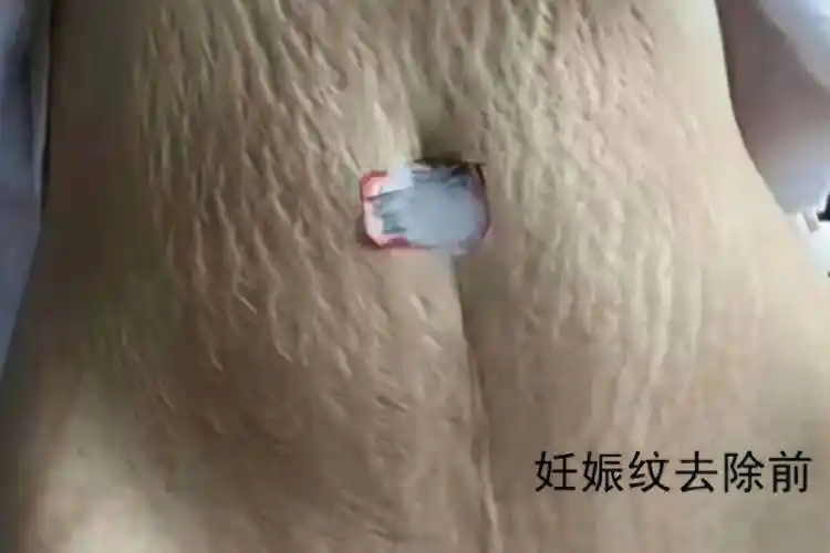 产后妊娠纹狰狞难看!7岁宝妈分享正确淡化方法!