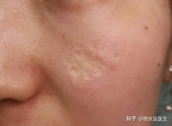 常见的凹陷疤痕瘢痕有哪几种
