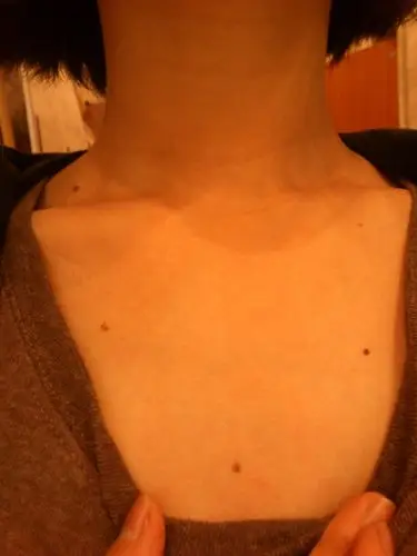 脖子7颗痣呈项链状排列,胸口正中一颗,背后正中一颗,之前形状是缺失的