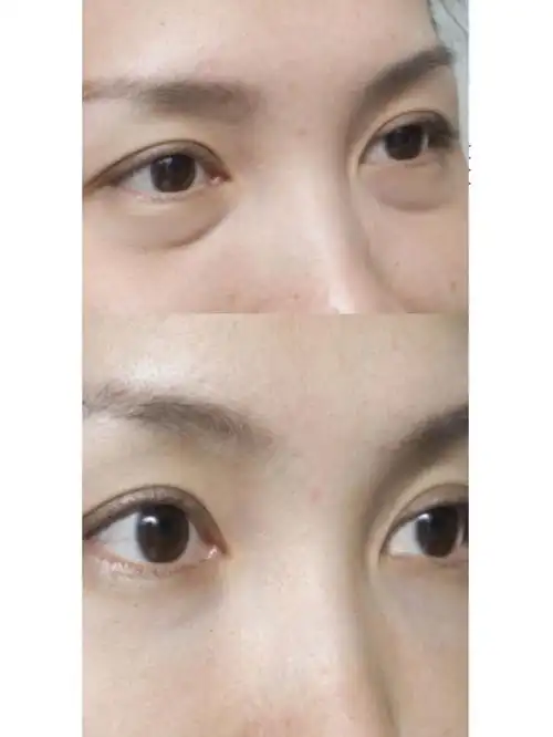 人到中年泪沟就出来了非常显老,泪沟玻尿酸填充是一个不错的选择.