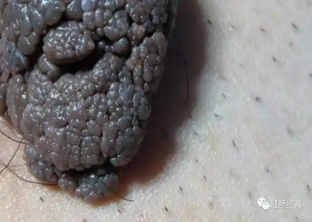 肛周尖锐湿疣直肠息肉,从肛门内脱出,质脆易出血,绒毛状癌变率高.