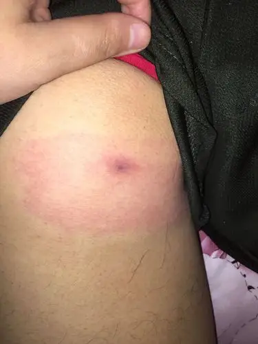 屁屁上长了一个痘痘刚开始的时候是红肿现在发黑了特别痛,跟针刺一样!