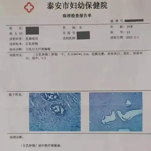 彩超提示"青春期巨大纤维腺瘤",大小约8.5*6.8*3.3cm.