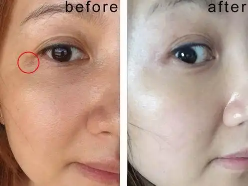 皮秒激光祛斑前后对比图(右脸)