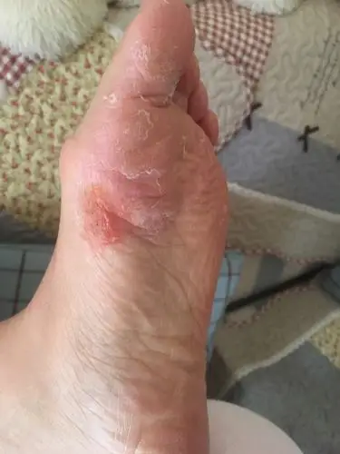 脚掌起皮,裂口,流脓,不痒,请问是什么问题?怎么办呢?