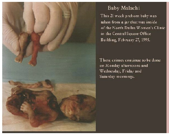 打胎真实照片触目惊心