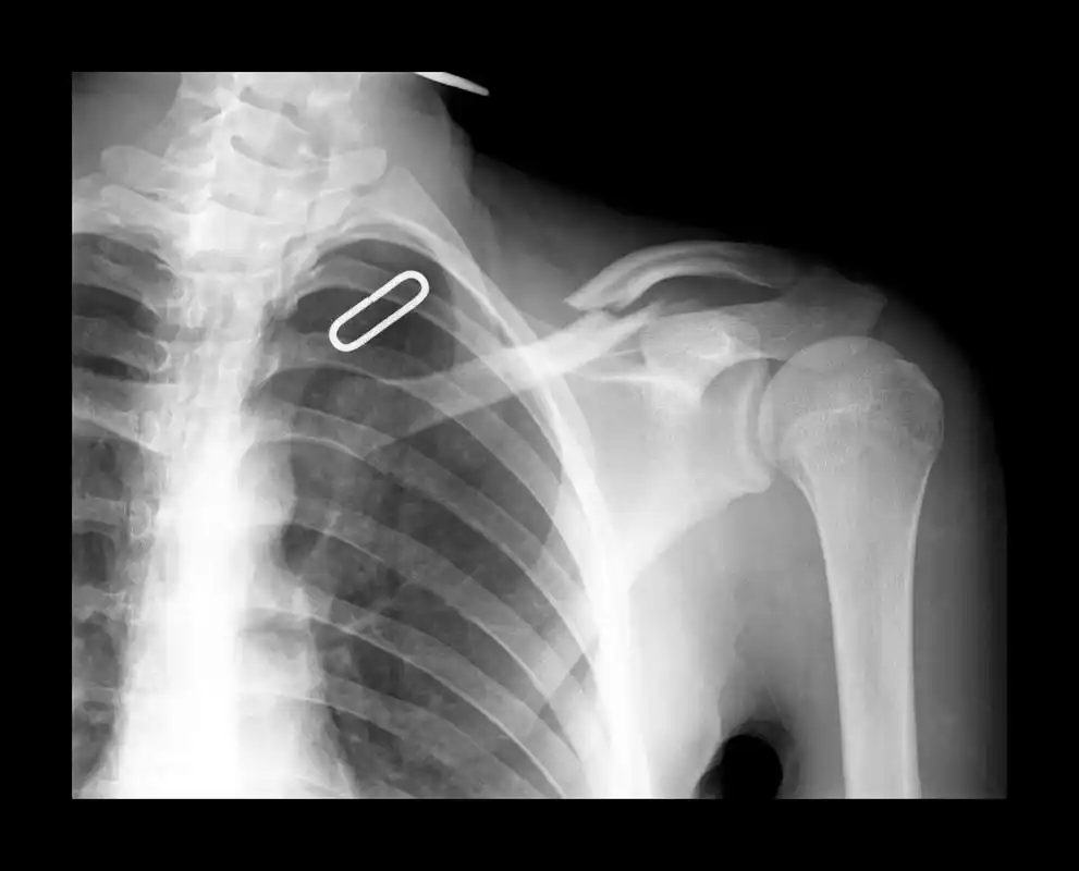 如何缓解肩胛骨疼痛,5个锻炼方法来帮你,做完马上缓解 肩胛骨疼痛可能