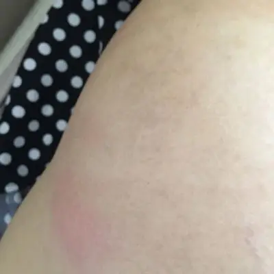 打黄体酮2个月,现在屁股打针处又红又肿,今天还有点痒,有没有和我一样