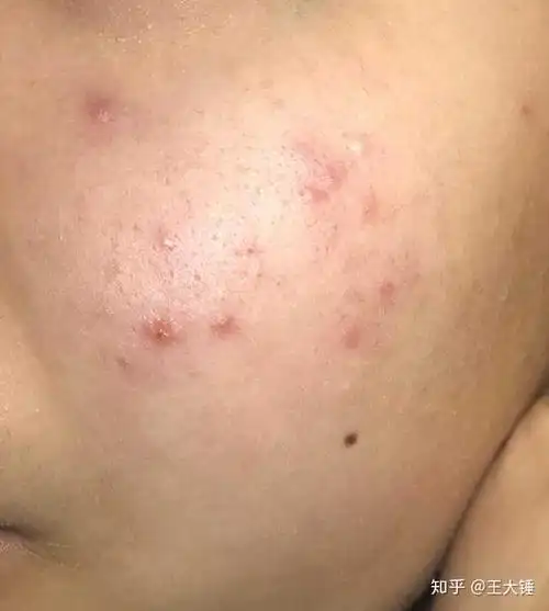 脸上有小痘痘怎么消除脸上有痘痘该怎么解决