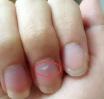 感染乙肝病毒后患者可能就会出现指甲发白这一症状,但是其他因素也能