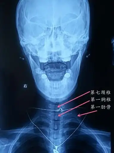 一招教你如何读懂颈椎正位片