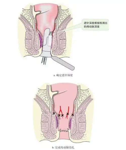 超声多普勒引导下痔动脉结扎术