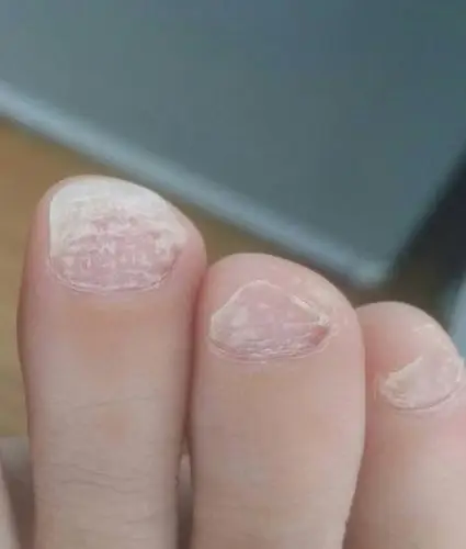 脚趾甲变白,不痛不痒,如图,不知有无大神给诊断一下,什么病症,怎么治