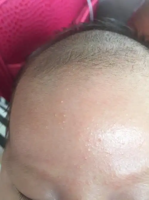 麻烦各位宝妈帮我看看小孩额头上白色的小颗粒是什么, | 妈妈网轻聊