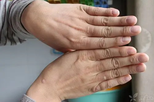 双手第一指骨背侧皮肤对称性糙皮病样外观,是什么疾病?
