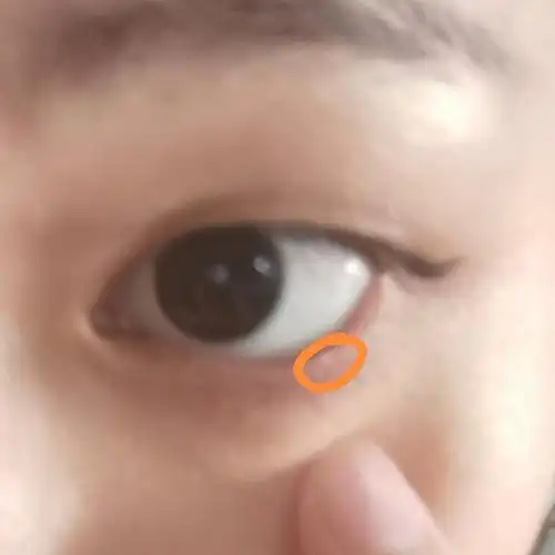内眼脂肪粒怎么办