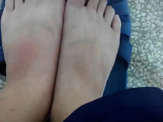 左脚背昨天晚上有一点点疼.今天早上就疼的受不了了.走路疼.