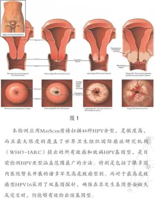 人乳头状瘤病毒(hpv)46种亚型检测评价