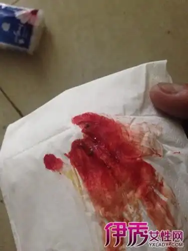 大便拉血的便血护理