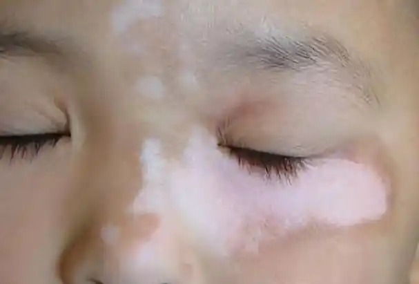 一种由于皮肤黑素细胞被破坏,导致皮肤因黑色素缺乏而出现白斑的疾病
