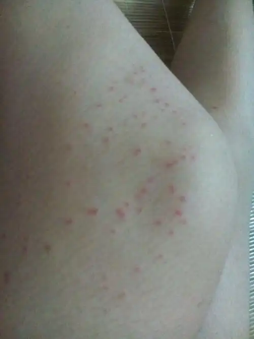 被蚊子咬的红色点点,有什么办法消除吗?求大神