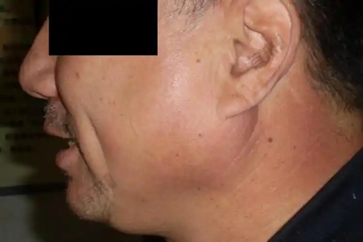 腮腺炎的症状图片